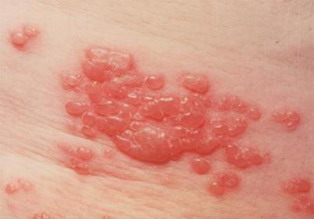 Skin Rash Skin Rash