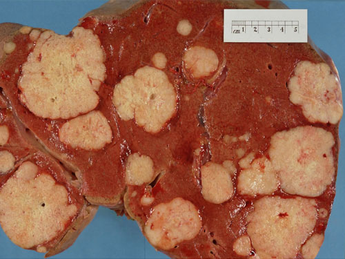 What causes lung cancer? What causes lung cancer?