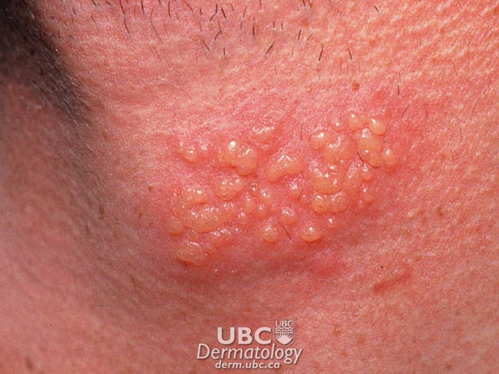 signs of herpes. Herpes Simplex 1 Treatment