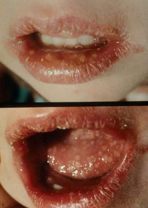 herpes simplex mouth. Picture 2 : Herpes Simplex