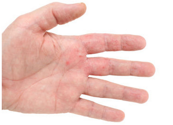 How do you identify a rash on your fingers?