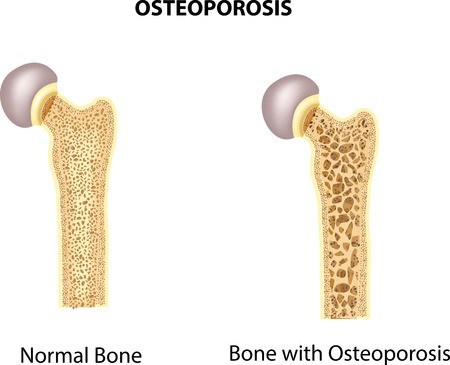 Perimenopause and Osteoporosis