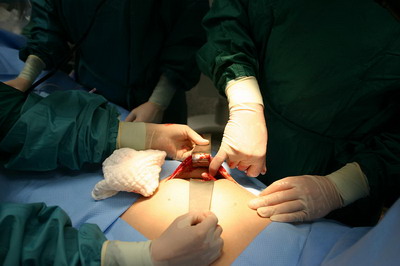 Appendix pain surgery