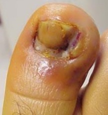 infected ingrown toenail