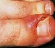 inflammation of the nail bed