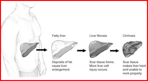 stages of liver disease