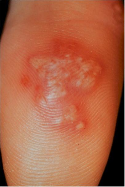 Herpes simplex type 1 pictures
