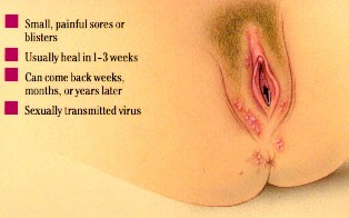 Vaginal Herpes