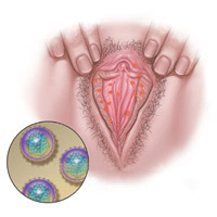 Vaginal Herpes photos
