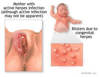 genital herpes pictures on women
