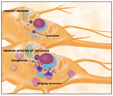 Tay Sachs disease neuron nerve