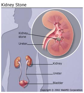 kidney stone pictures