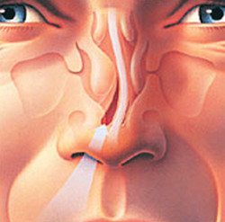 Deviated nasal Septum