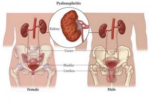 Acute and Chronic Pyelonephritis