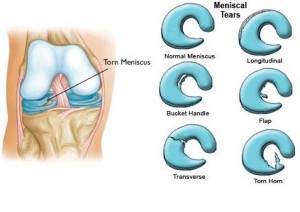 Meniscus Tear