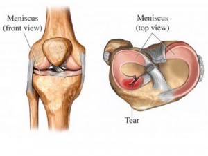 Torn Meniscus