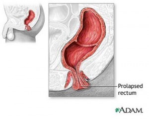 prolapsed rectum 