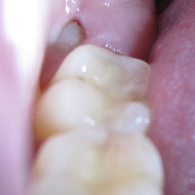Impacted Wisdom Tooth picture