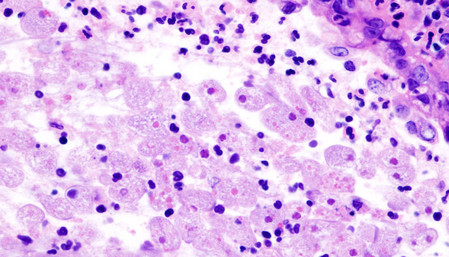 Amoebic dysentery in colon biopsy