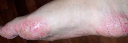 Dyshidrotic Dermatitis on feet