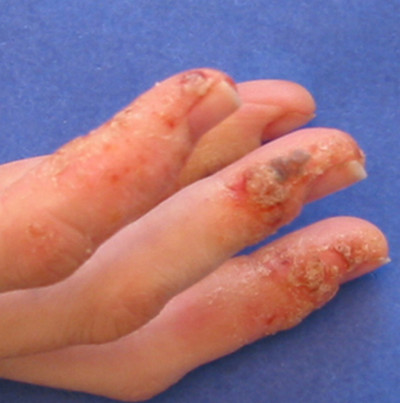 Dyshidrotic Dermatitis on finger