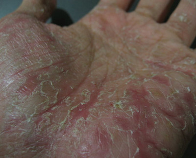 Dyshidrotic Dermatitis on palm