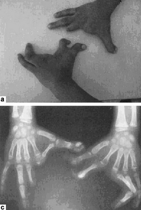 Ectrodactyly hand fingers