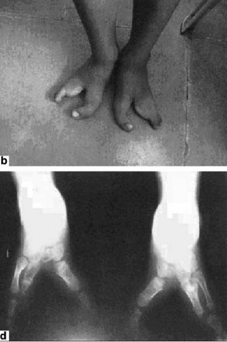 Ectrodactyly leg foot