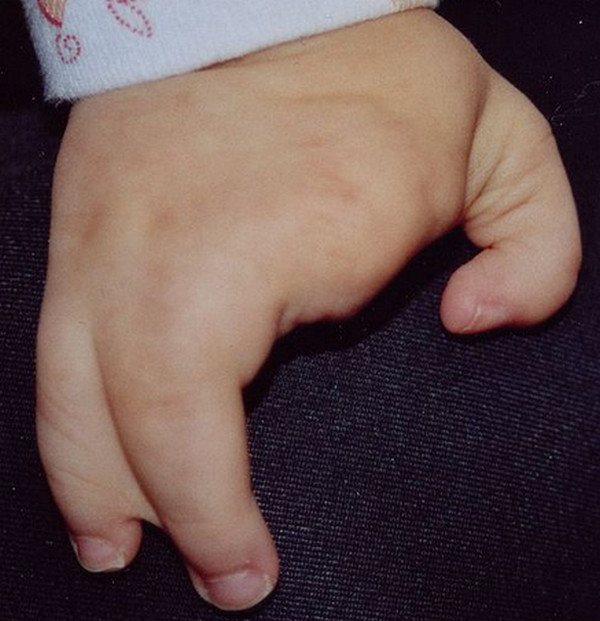 Ectrodactyly picture