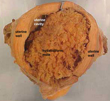 Gestational Trophoblastic Disease