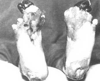 Trench Foot image