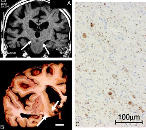 coticobasal degeneration