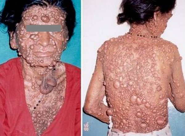 hamartomas, symptom of Cowden Syndrome image