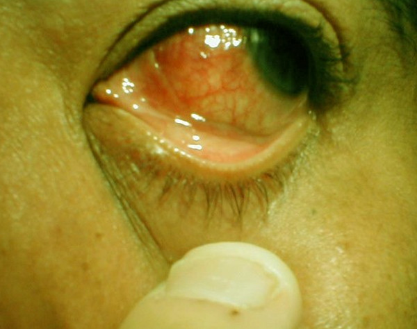 scleritis images