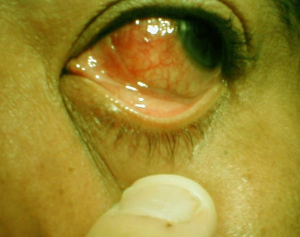 scleritis images
