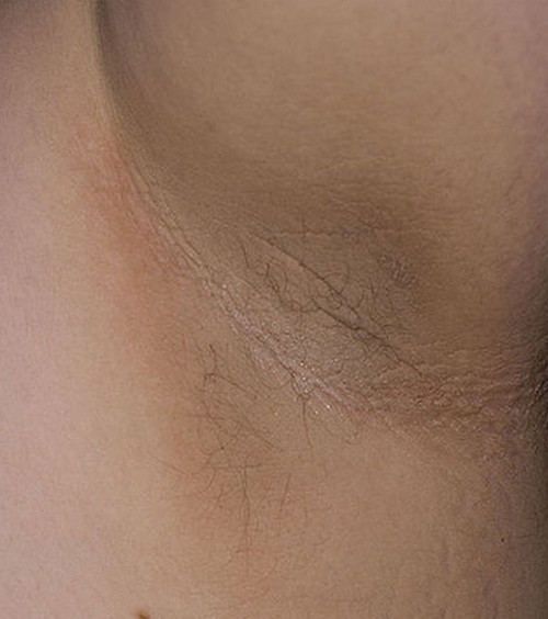 Acanthosis Nigricans axilla
