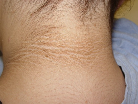 Acanthosis Nigricans neck