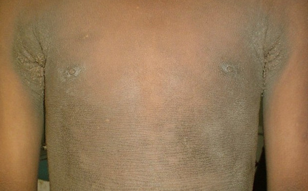 Acanthosis Nigricans pictures