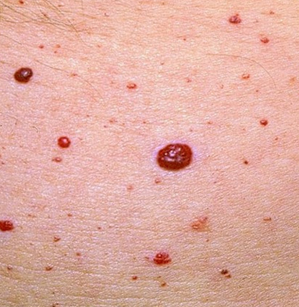 Cherry Angioma Causes Pictures Diagnosis Treatment And Removal