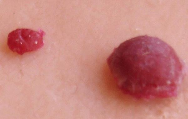 Cherry Angioma photo