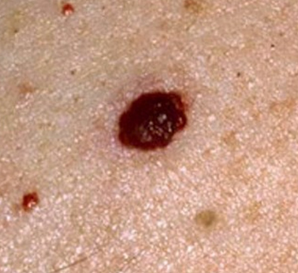 Cherry Angioma pictures