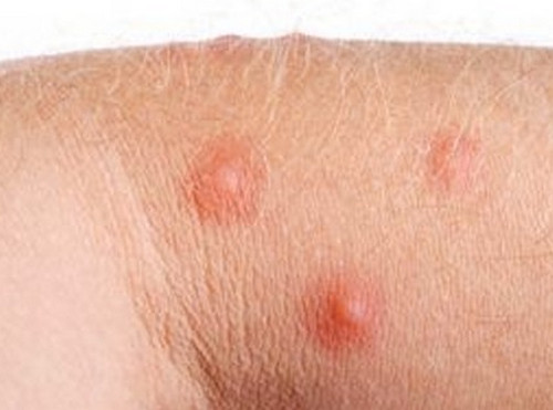 Cherry Angioma