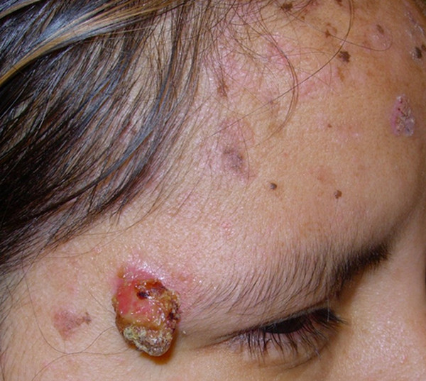 Epidermodysplasia verruciformis picture