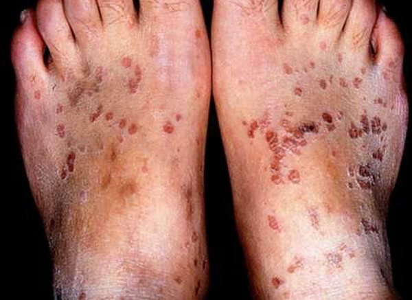 Epidermodysplasia verruciformis