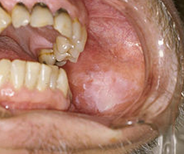 leukoplakia image