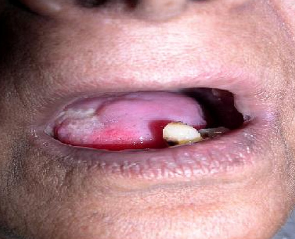 leukoplakia on tongue picture