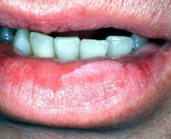 leukoplakia photo