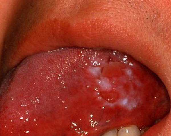 leukoplakia