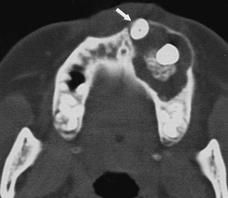 Adenomatoid Odontogenic Tumor CT picture