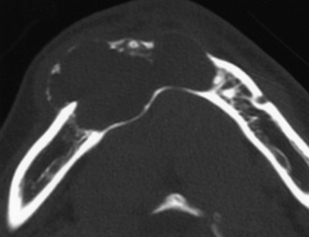 Calcifying Odontogenic Cyst CT image